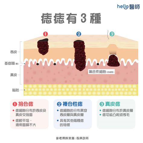 身上痣|痣變大、痣多或長毛會變皮膚癌？認識痣的形成與原因